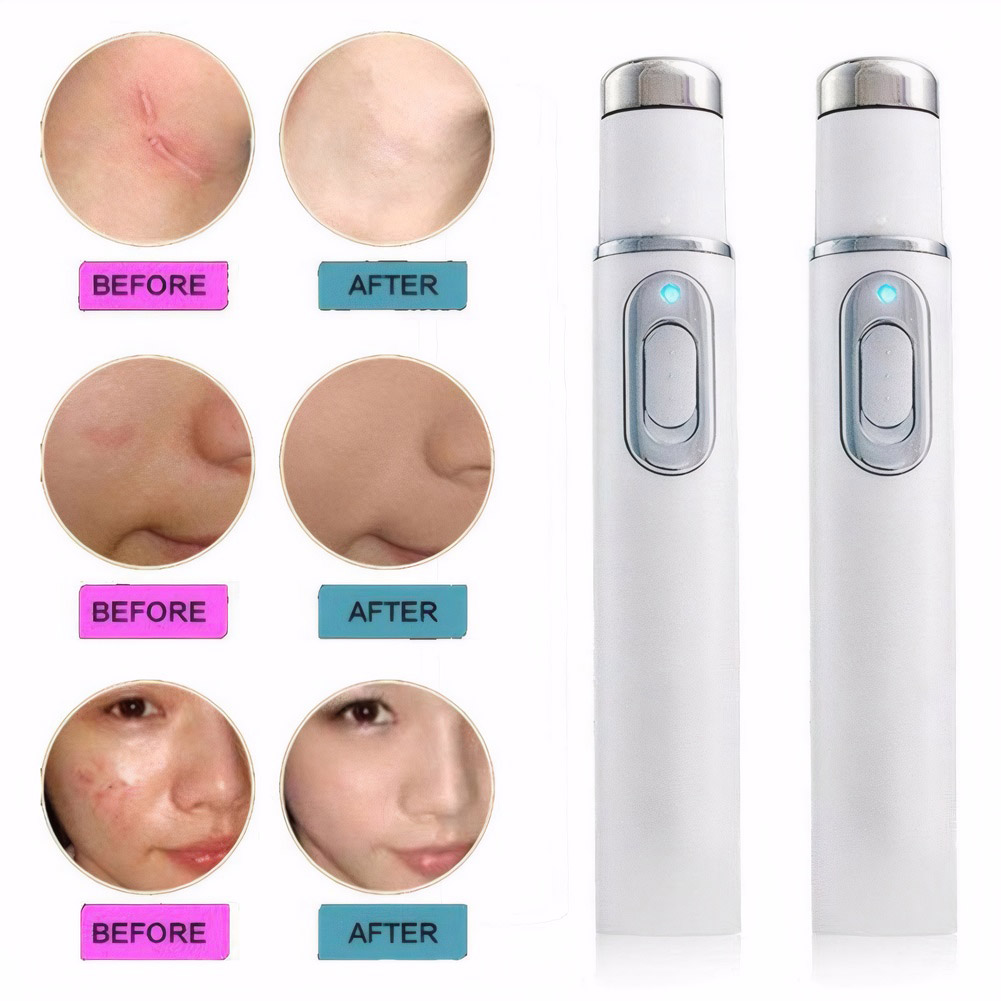 Terapi Cahaya Biru Pena Jerawa - Acne Light Therapy Pen ulasan dan harga